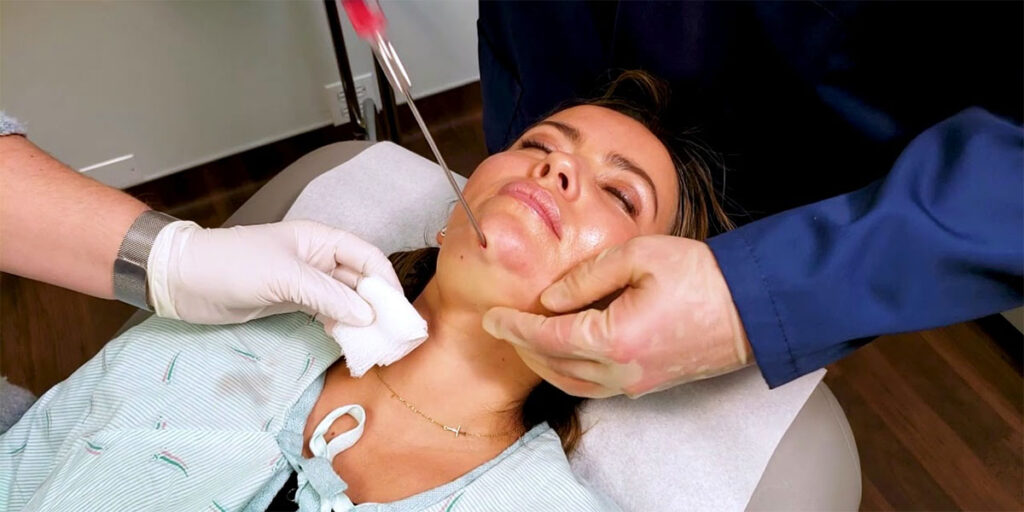 Facial liposuction procedure.