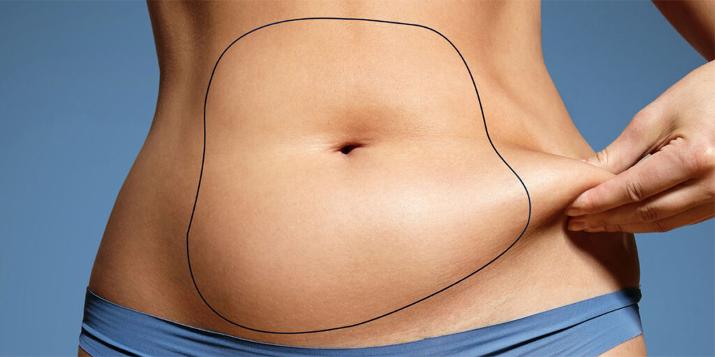 Patient before and after abdominal liposuction.