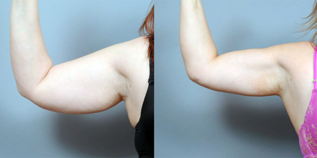 Before and after of an arm liposuction patient.