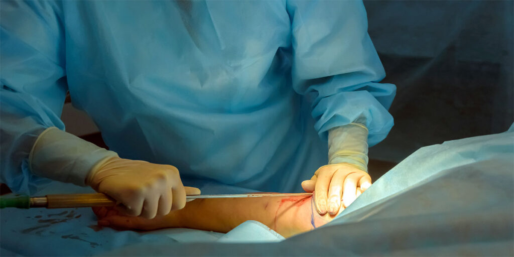 A patient undergoing arm liposuction.