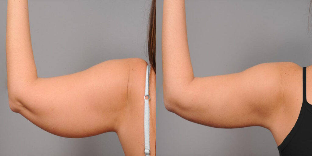 Before and after results from arm liposuction.