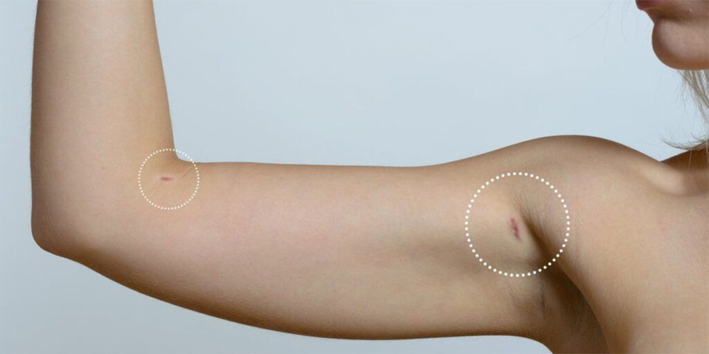 Arm liposuction scar.