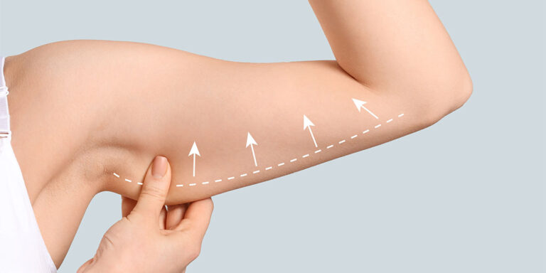 Arm Liposuction: Your Ticket to Toned Arms