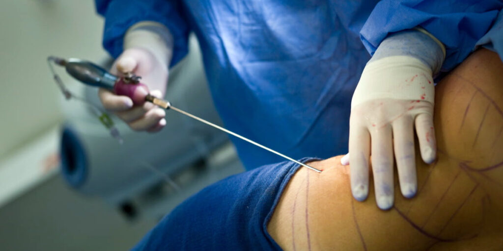 A surgeon performing liposuction.