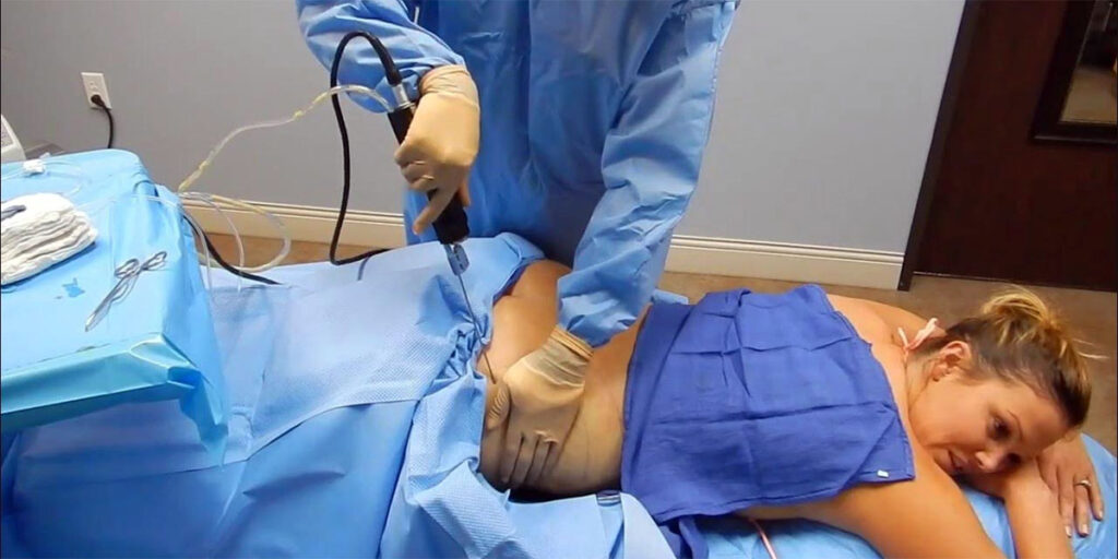 A surgeon performing awake liposuction.