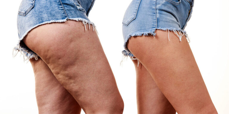 Does Liposuction Get Rid of Cellulite?