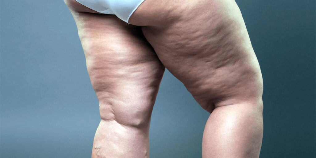 A woman's legs with celulite.