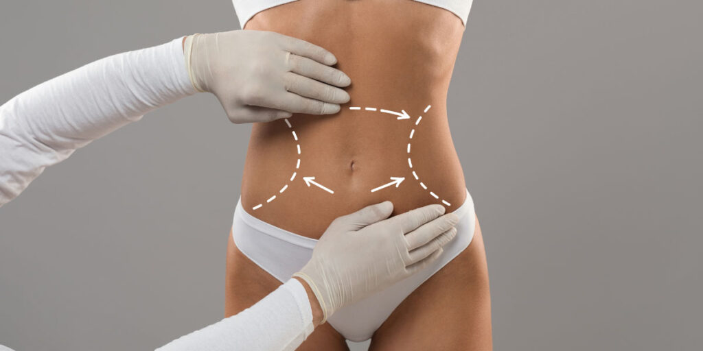 A surgeon mapping a women's abdomen for liposuction.