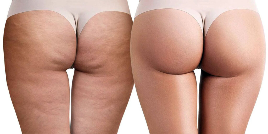 Liposuction and Cellulite: The Connection