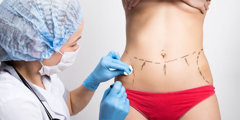 Close-up of a doctor marking a patient’s stomach for liposuction.