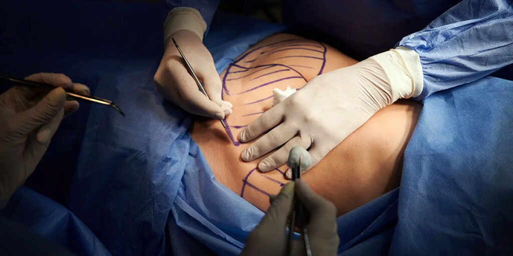 The Liposuction Procedure: What Does It Feel Like?