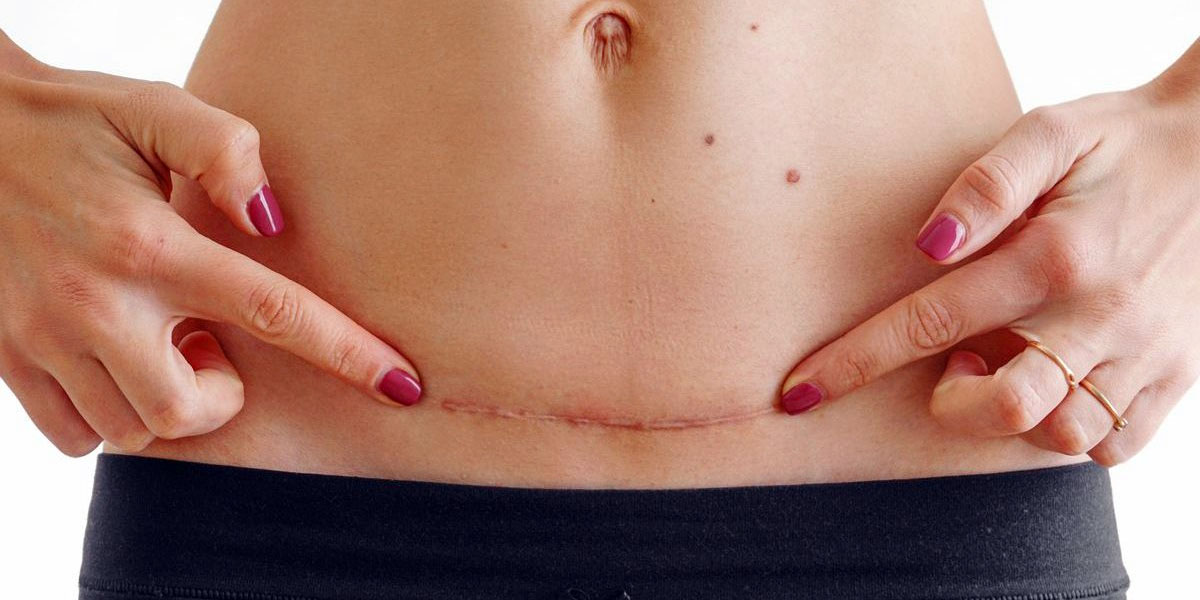 Does liposuction leave scars?