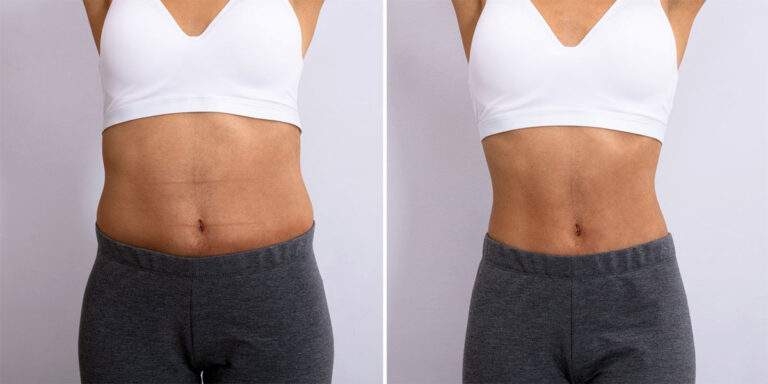 How Much Is Liposuction?