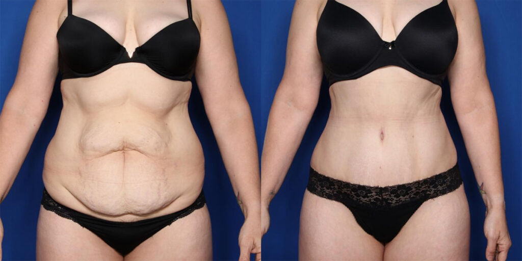 before and after of a tummy tuck