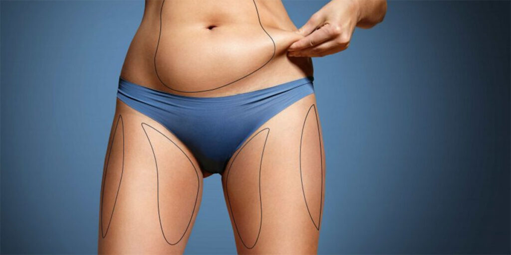 Is Liposuction Right for Me?