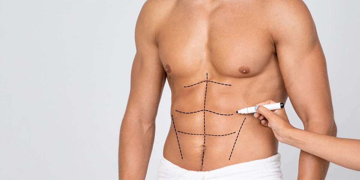 Liposuction for men