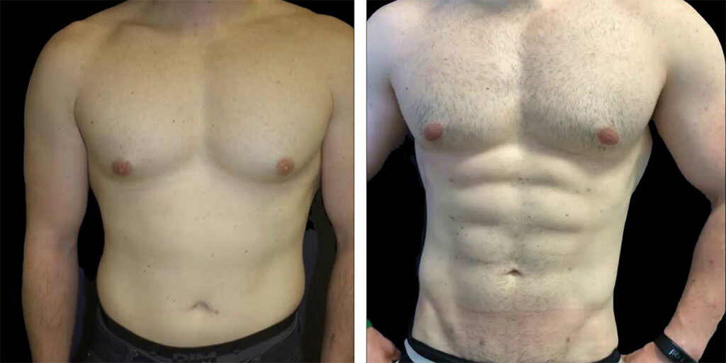 Male Liposuction Before and After