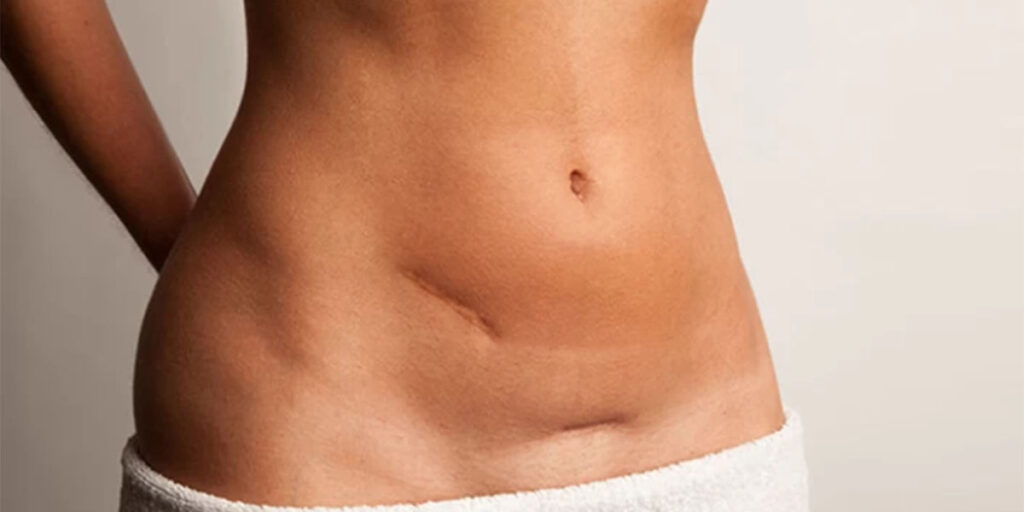 liposuction scars