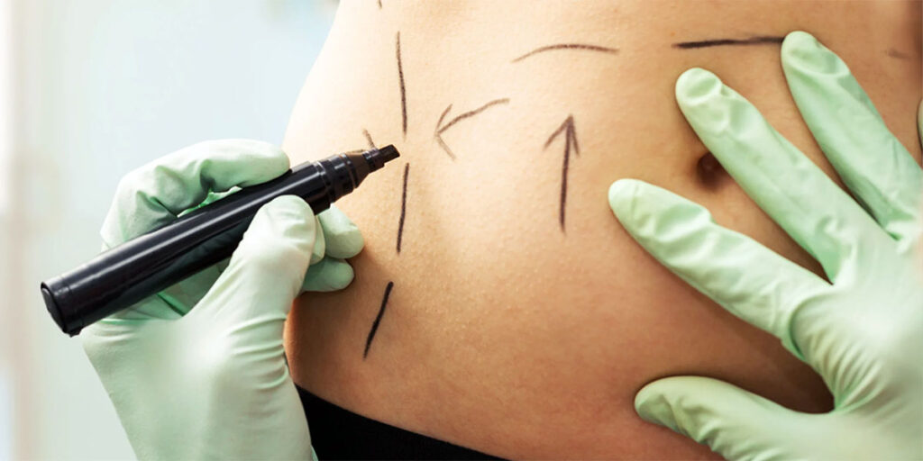 What is liposuction?