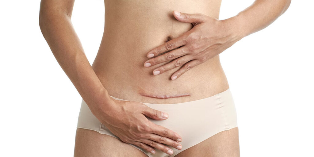 Is Liposuction Permanenet?