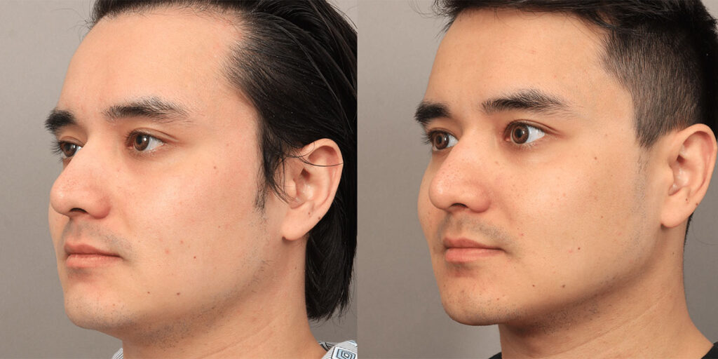 Submental Liposuction for Men