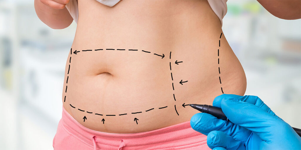 Plastic surgeon marking areas for liposuction on a patient’s abdomen.