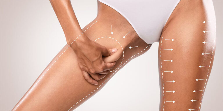 thigh liposuction