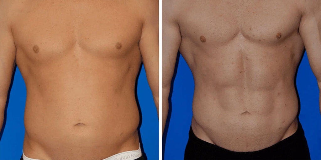 Before and after shots of VASER liposuction.