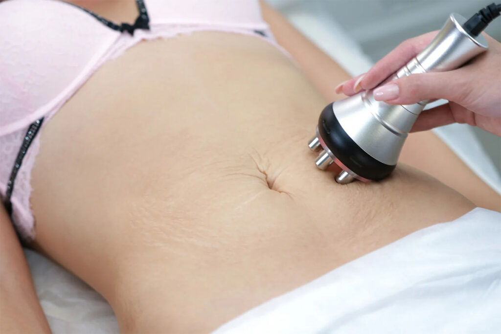 Radiofrequency (RF) Fat Reduction